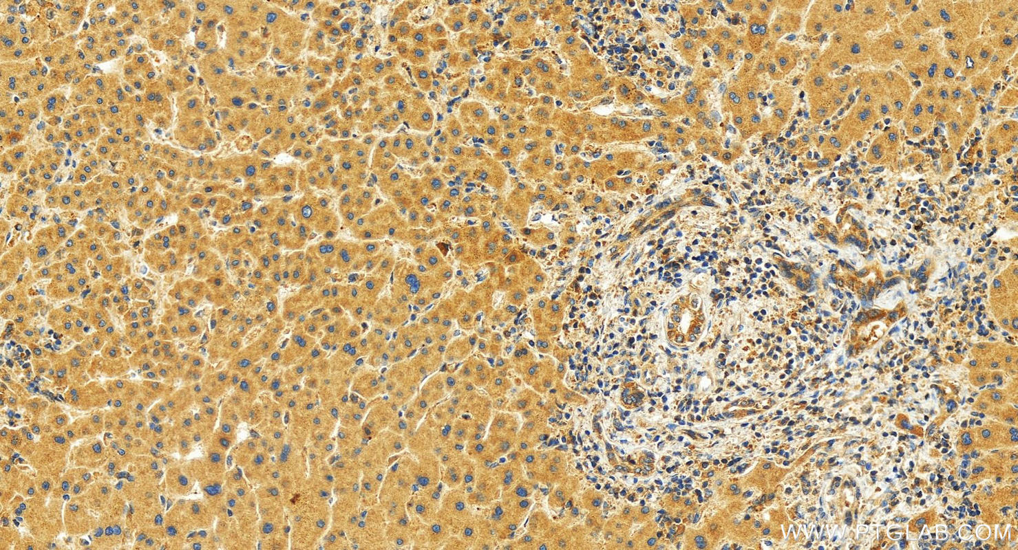 Immunohistochemistry (IHC) staining of human intrahepatic cholangiocarcinoma tissue using Pericentrin Polyclonal antibody (22271-1-AP)