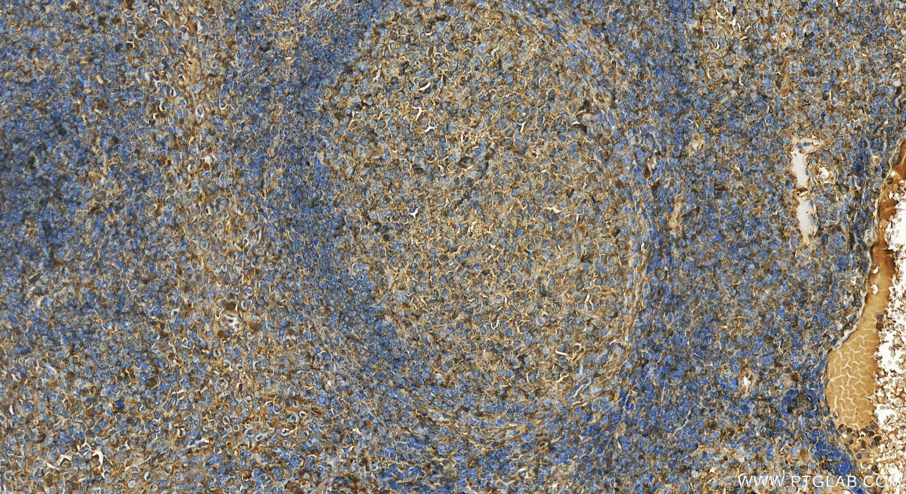 Immunohistochemistry (IHC) staining of human tonsillitis tissue using Phospho-BCL2 (Ser70) Recombinant antibody (80771-2-RR)