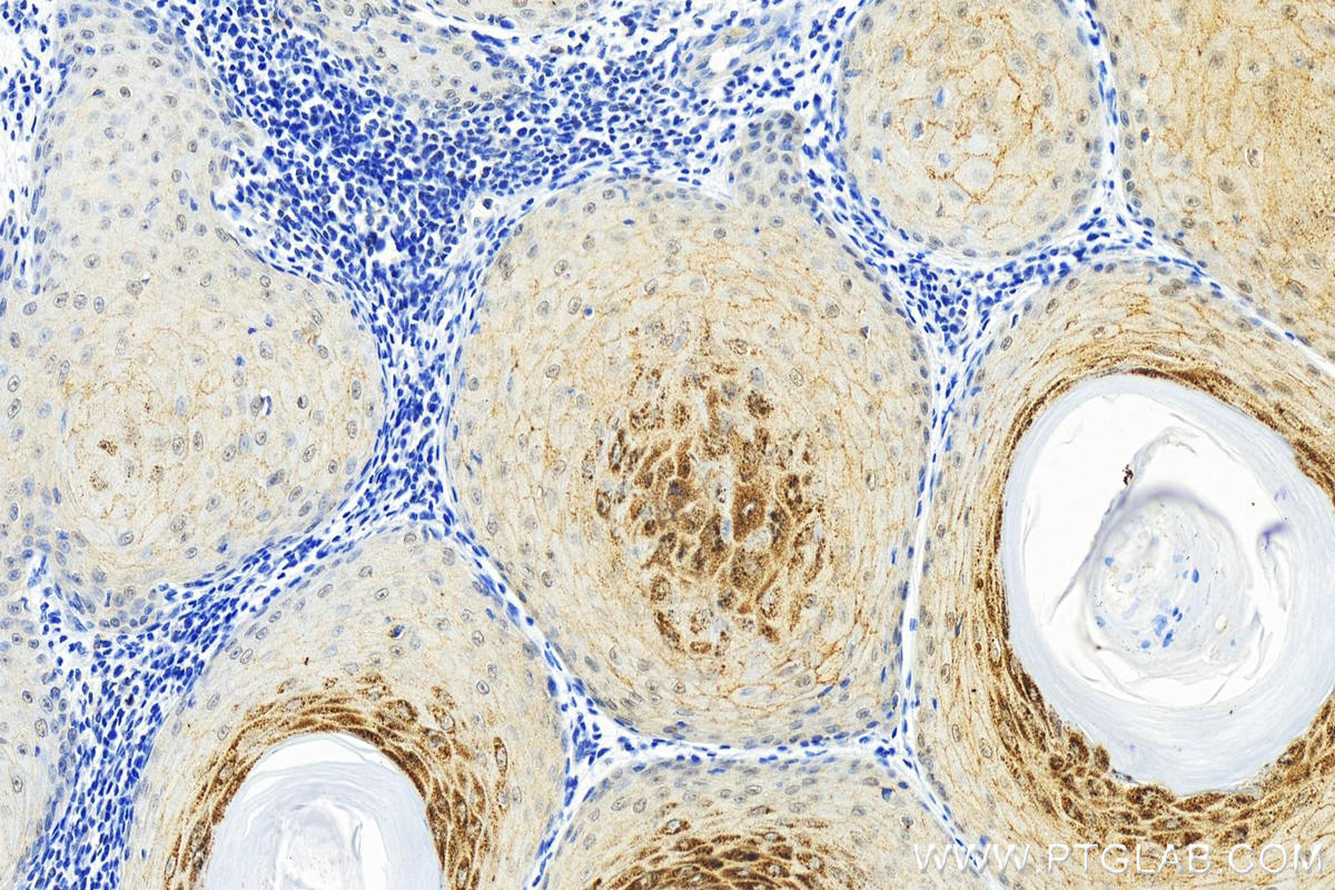 Immunohistochemistry (IHC) staining of human skin cancer tissue using Phospho-IkB Alpha (Ser32/36) Recombinant antibody (82349-1-RR)