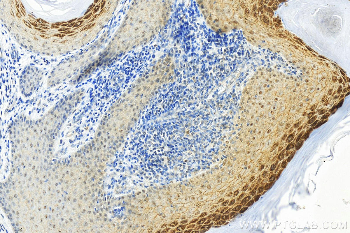 Immunohistochemistry (IHC) staining of human skin cancer tissue using Phospho-IkB Alpha (Ser32/36) Recombinant antibody (82349-1-RR)