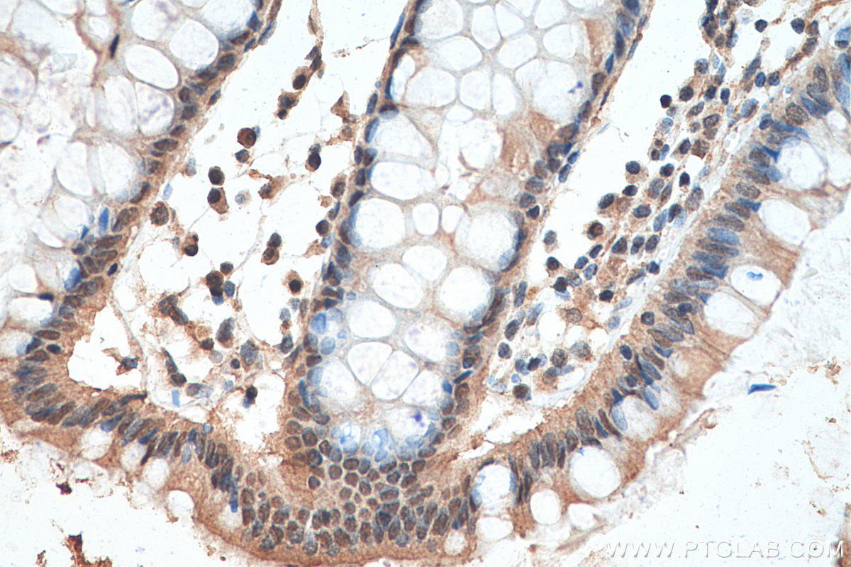 Immunohistochemistry (IHC) staining of human colon cancer tissue using Phospho-P53 (Ser46) Monoclonal antibody (67900-1-Ig)