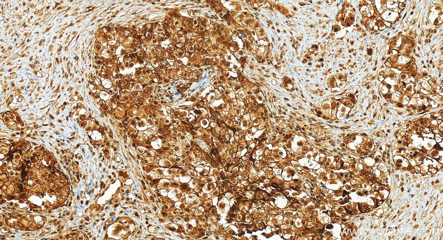 Immunohistochemistry (IHC) staining of human ovary cancer tissue using Plakophilin 2 Polyclonal antibody (26479-1-AP)