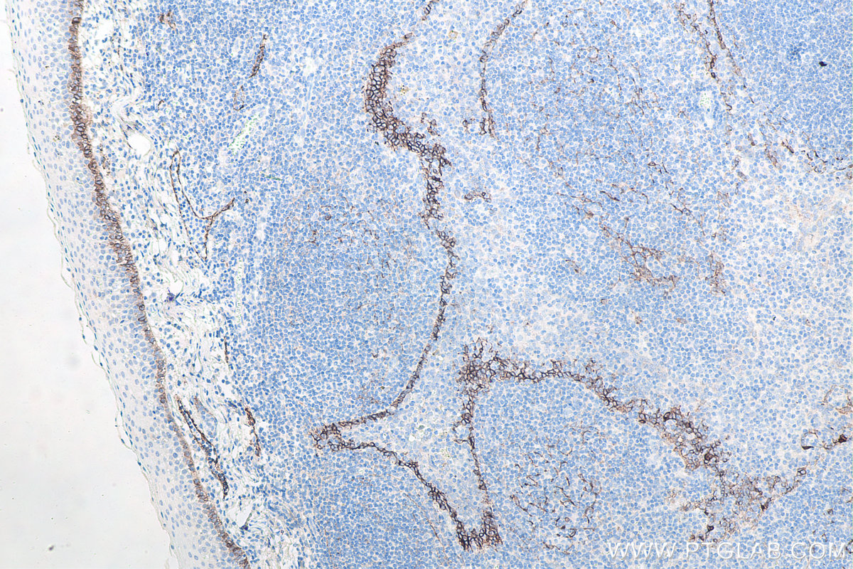 Immunohistochemistry (IHC) staining of human tonsillitis tissue using Podoplanin Monoclonal antibody (67432-1-Ig)