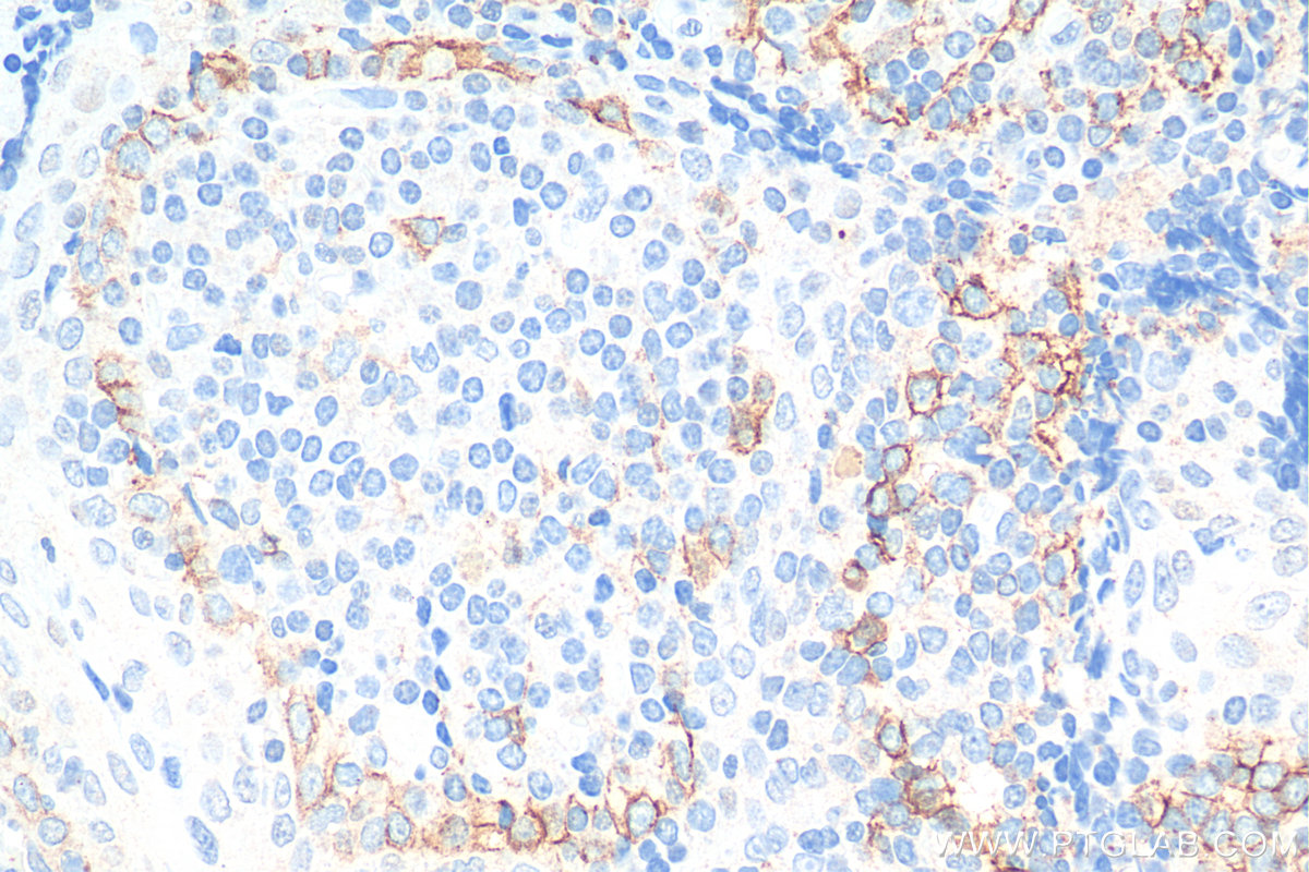 Immunohistochemistry (IHC) staining of human tonsillitis tissue using Podoplanin Monoclonal antibody (67432-1-Ig)