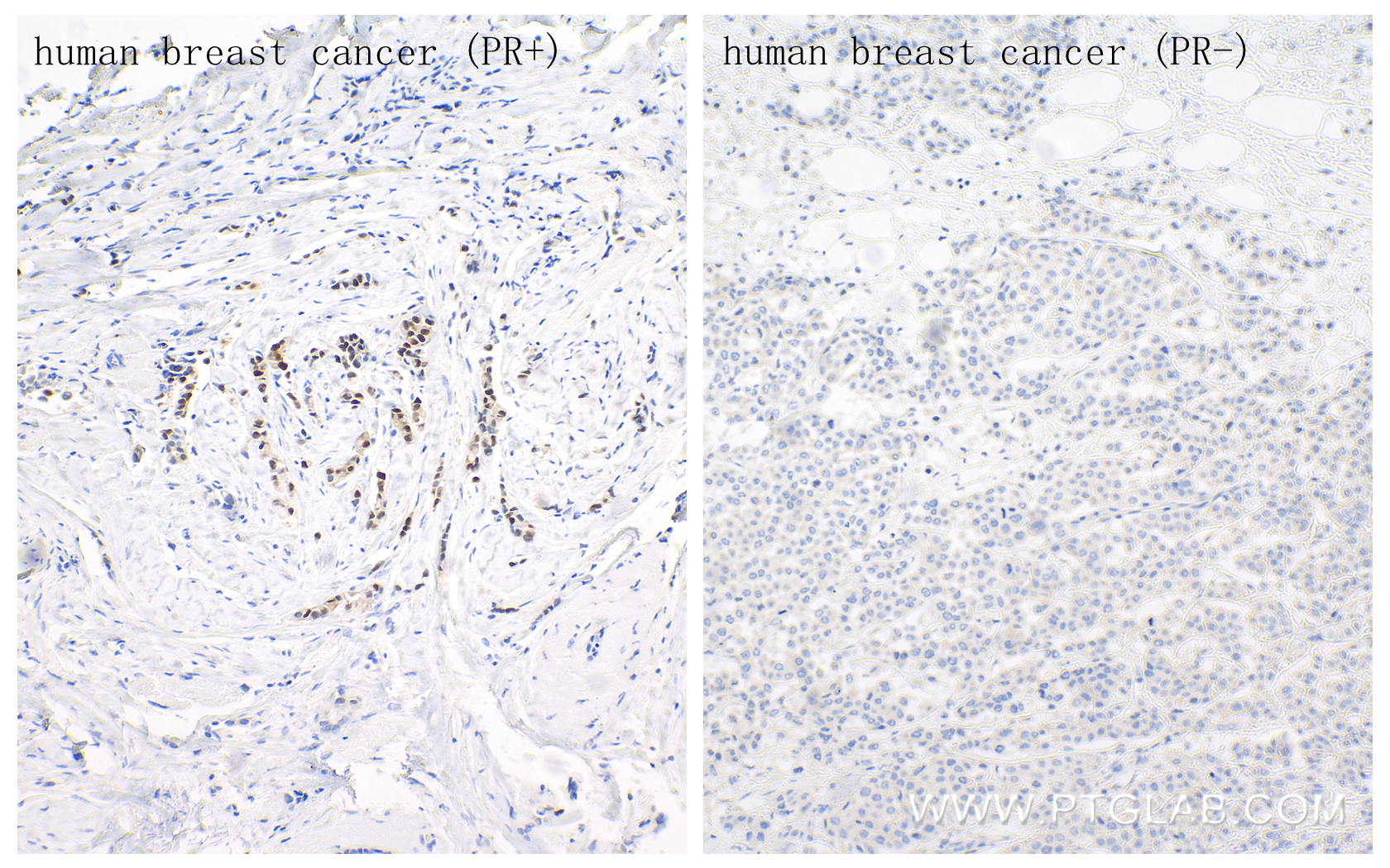Immunohistochemistry (IHC) staining of human breast cancer tissue using Progesterone Receptor Recombinant antibody (85112-4-RR)