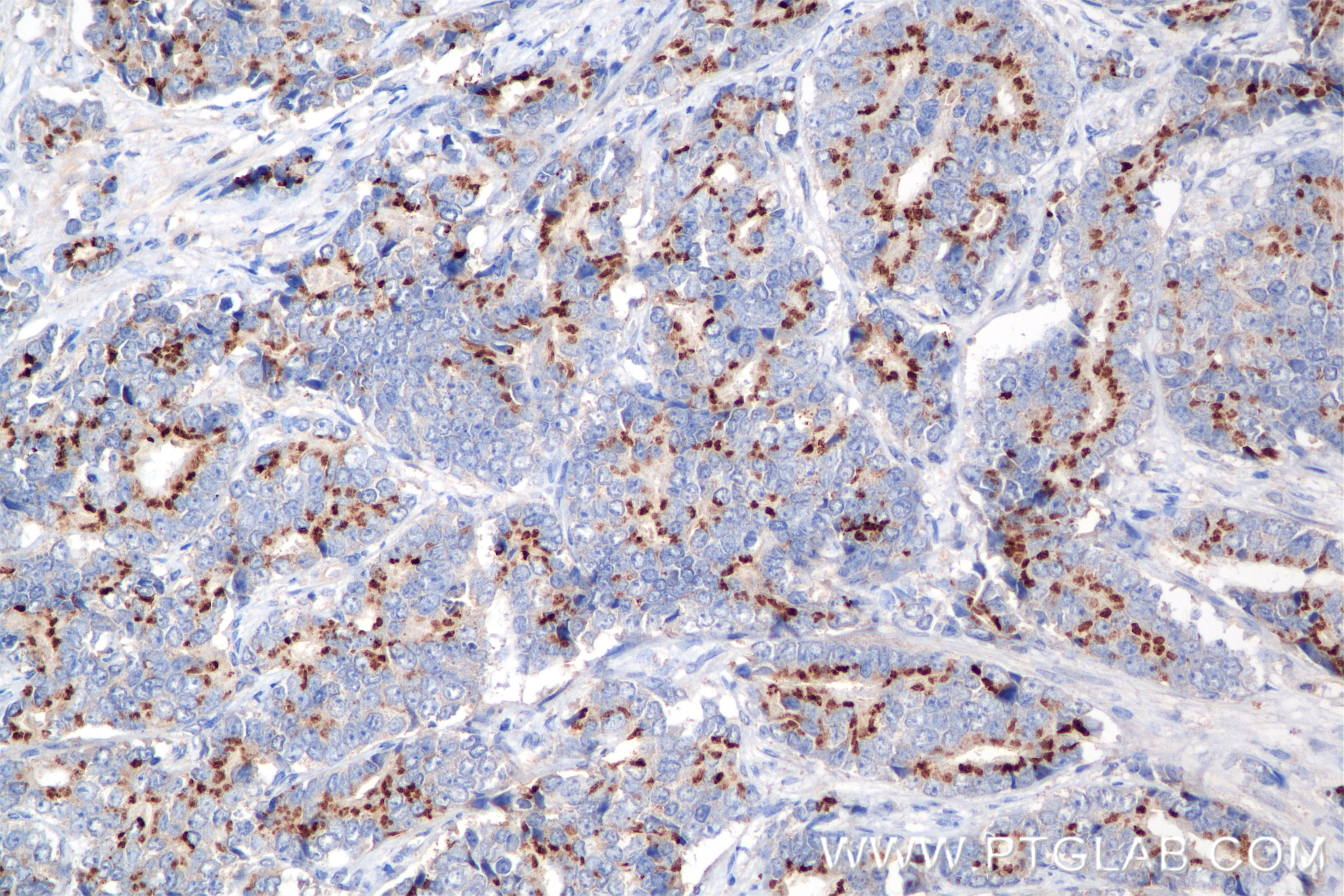 Immunohistochemistry (IHC) staining of human prostate cancer tissue using Prostein Recombinant antibody (84629-2-RR)