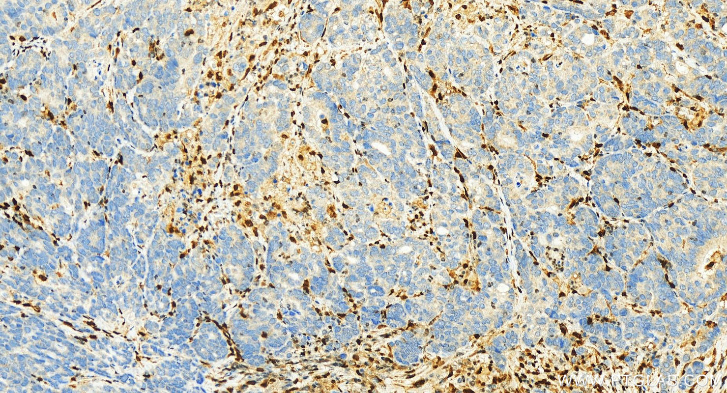 Immunohistochemistry (IHC) staining of human stomach cancer tissue using QKI Polyclonal antibody (13169-1-AP)