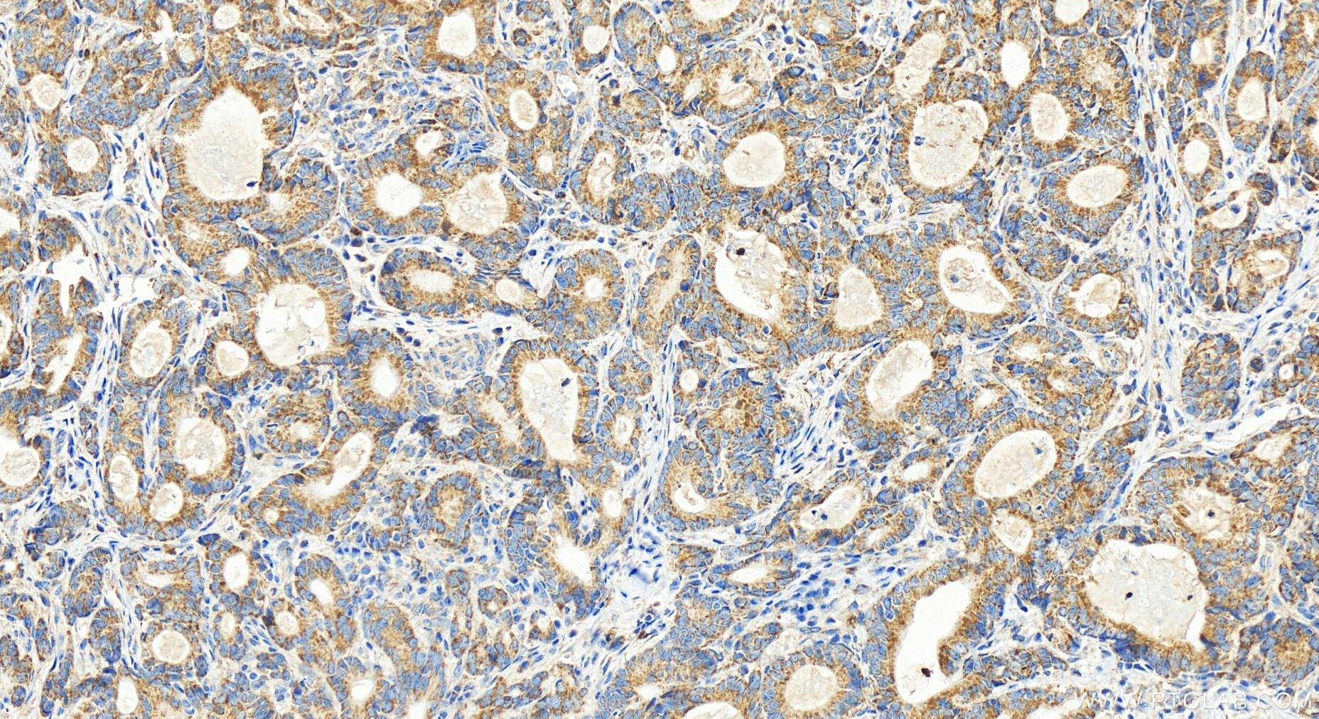 Immunohistochemistry (IHC) staining of human stomach cancer tissue using QRSL1 Polyclonal antibody (15926-1-AP)