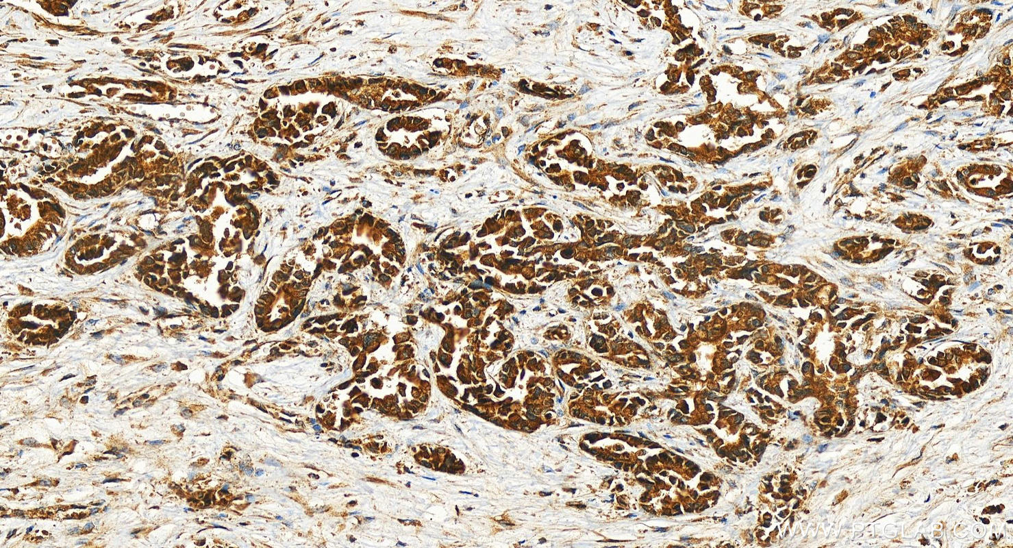 Immunohistochemistry (IHC) staining of human intrahepatic cholangiocarcinoma tissue using RAB17 Polyclonal antibody (28274-1-AP)