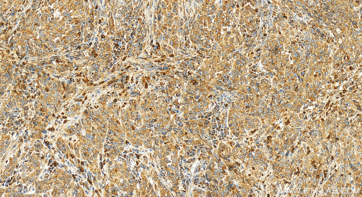 Immunohistochemistry (IHC) staining of human stomach cancer tissue using Rab18 Polyclonal antibody (11304-1-AP)