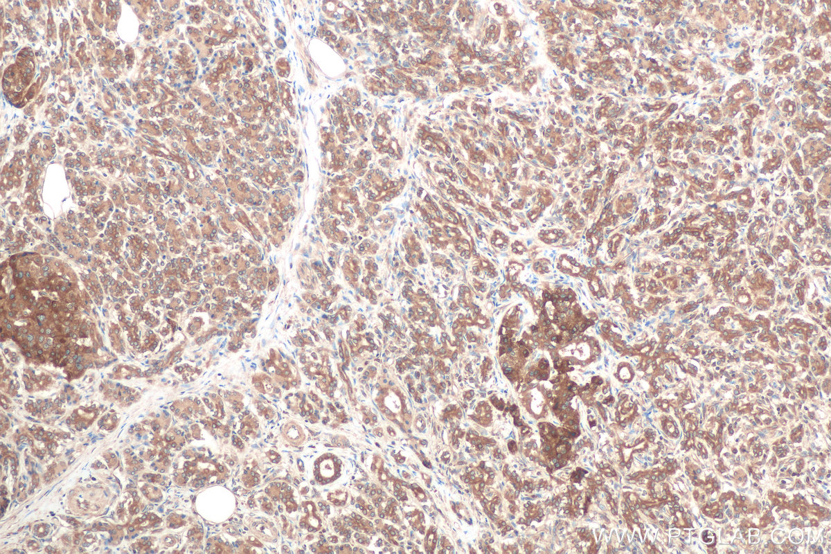 Immunohistochemistry (IHC) staining of human pancreas cancer tissue using RAB1B Monoclonal antibody (67837-1-Ig)