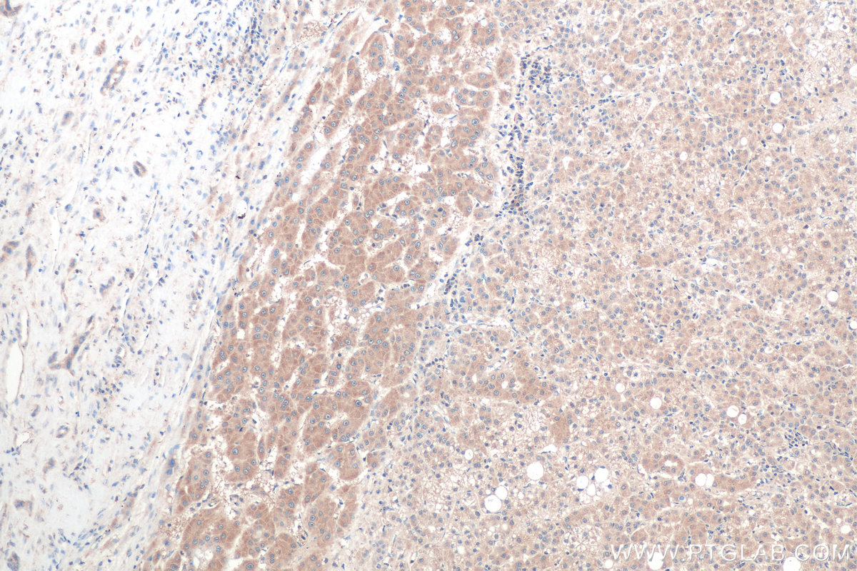 Immunohistochemistry (IHC) staining of human liver cancer tissue using RAB1B Monoclonal antibody (67837-1-Ig)