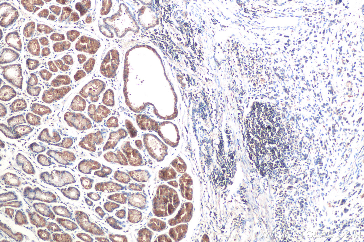 Immunohistochemistry (IHC) staining of human stomach cancer tissue using RAB1B Monoclonal antibody (67837-1-Ig)