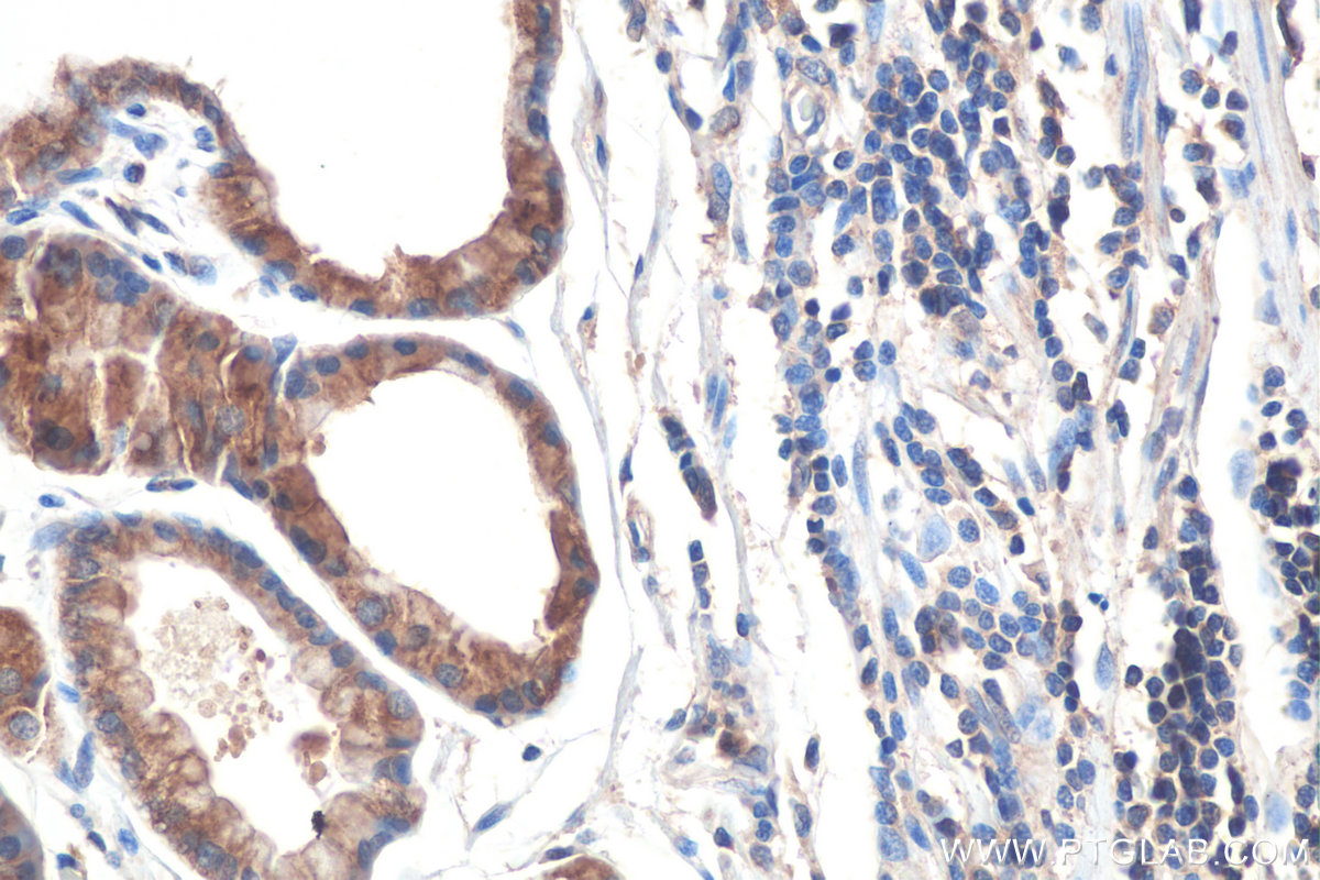 Immunohistochemistry (IHC) staining of human stomach cancer tissue using RAB1B Monoclonal antibody (67837-1-Ig)