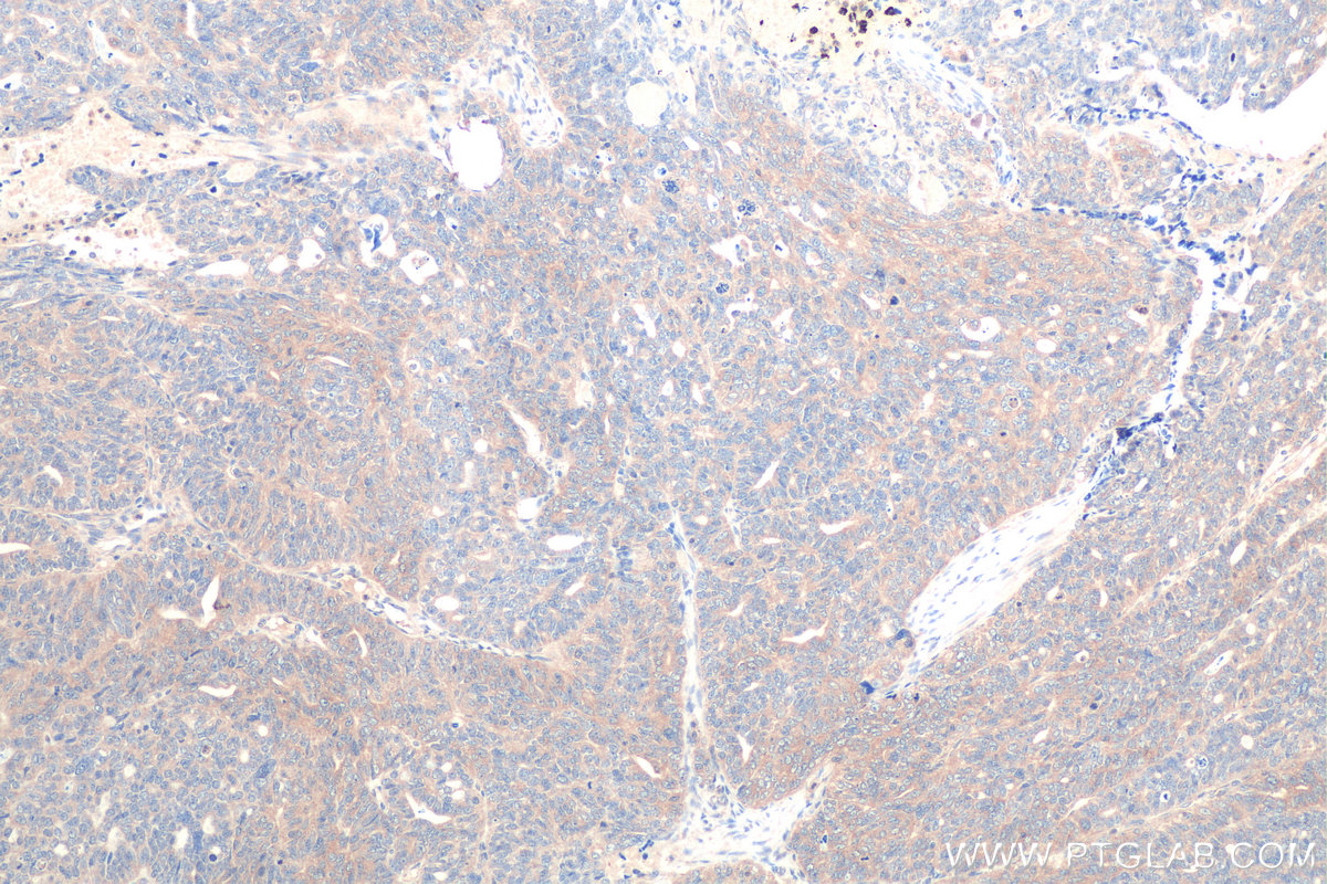 Immunohistochemistry (IHC) staining of human ovary tumor tissue using RAB1B Monoclonal antibody (67837-1-Ig)