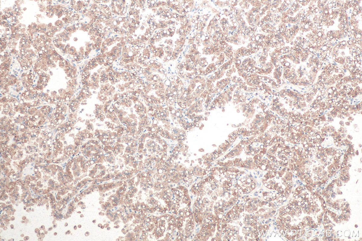 Immunohistochemistry (IHC) staining of human lung cancer tissue using RAB1B Monoclonal antibody (67837-1-Ig)