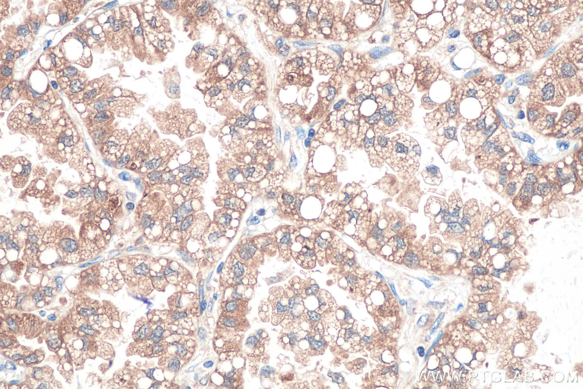 Immunohistochemistry (IHC) staining of human lung cancer tissue using RAB1B Monoclonal antibody (67837-1-Ig)