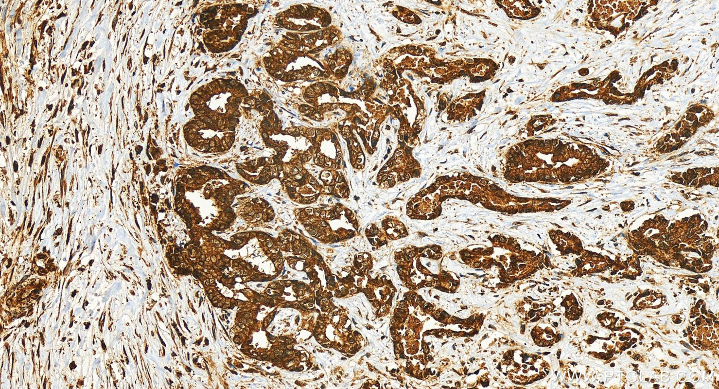 Immunohistochemistry (IHC) staining of human intrahepatic cholangiocarcinoma tissue using RAB32 Recombinant antibody (82960-5-RR)