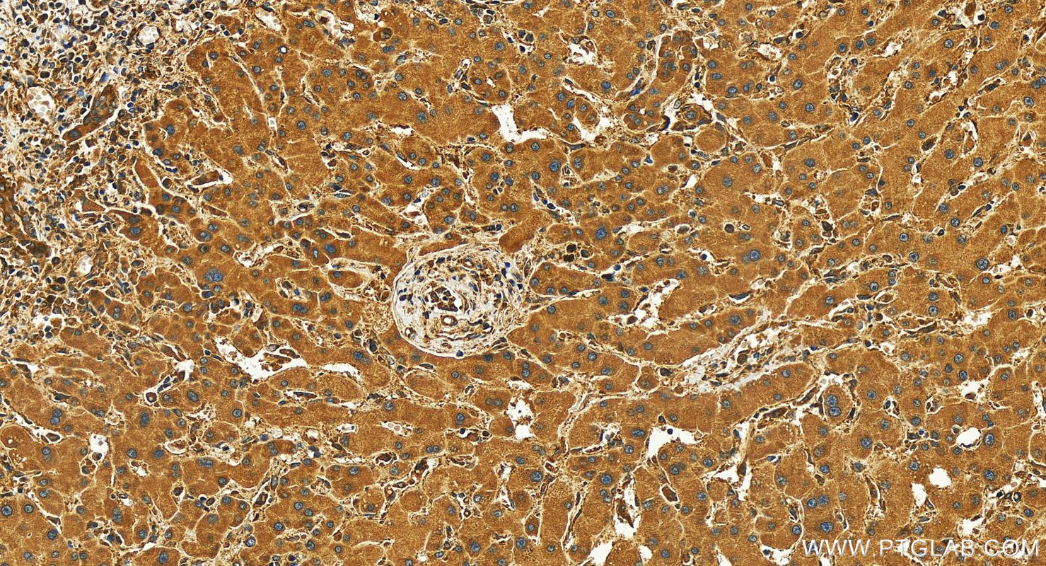 Immunohistochemistry (IHC) staining of human intrahepatic cholangiocarcinoma tissue using RAB32 Recombinant antibody (82960-5-RR)