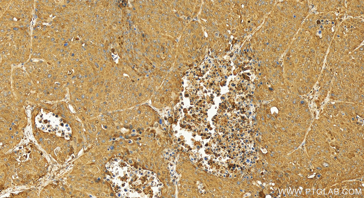 Immunohistochemistry (IHC) staining of human lung squamous cell carcinoma tissue using RABEPK/p40 Polyclonal antibody (10213-2-AP)