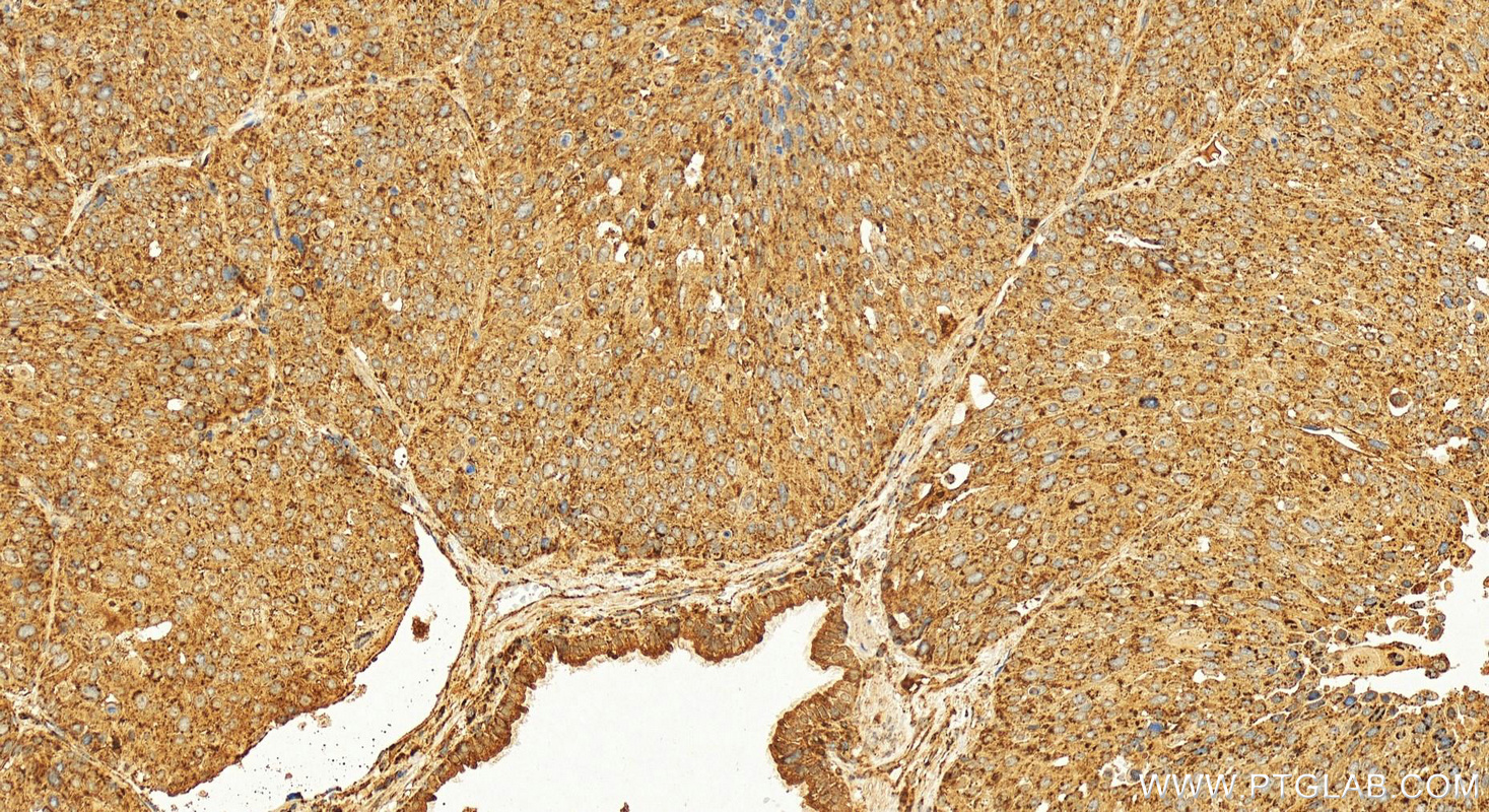 Immunohistochemistry (IHC) staining of human lung squamous cell carcinoma tissue using RABEPK/p40 Polyclonal antibody (15105-1-AP)