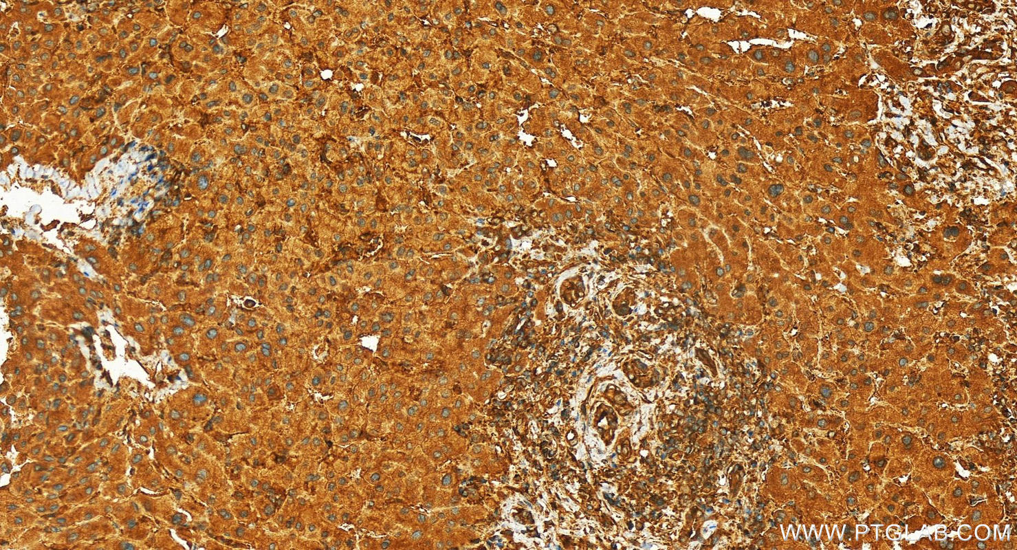 Immunohistochemistry (IHC) staining of human intrahepatic cholangiocarcinoma tissue using RABGAP1 Polyclonal antibody (14223-1-AP)