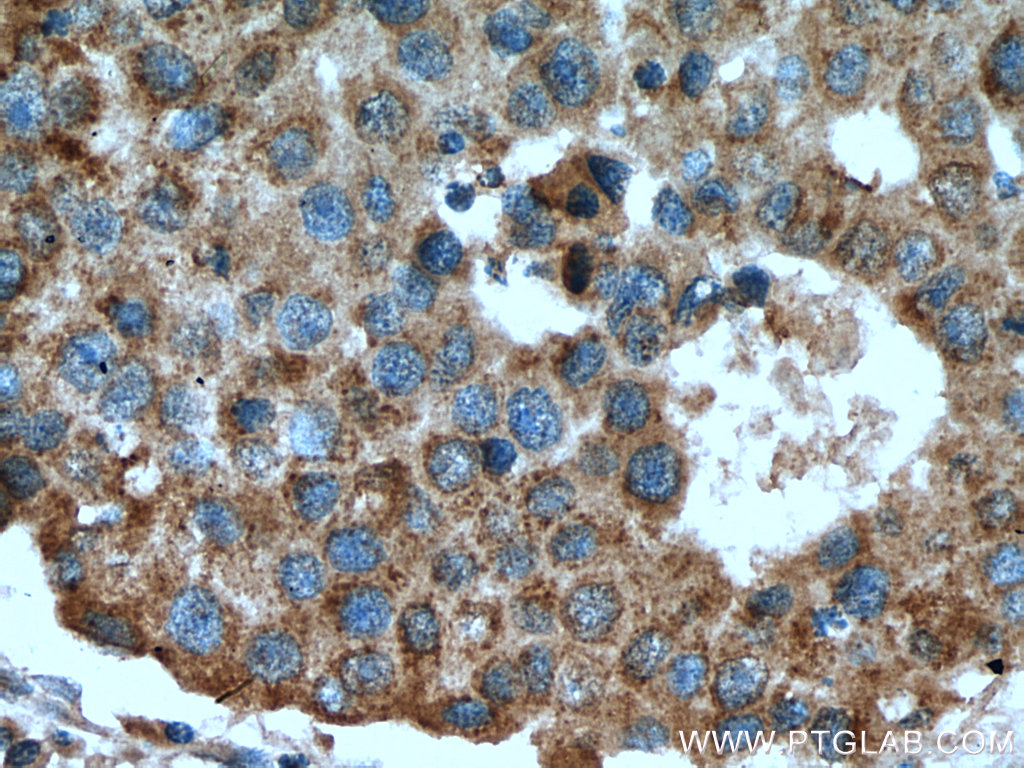 Immunohistochemistry (IHC) staining of human breast cancer tissue using RABIF Polyclonal antibody (29113-1-AP)