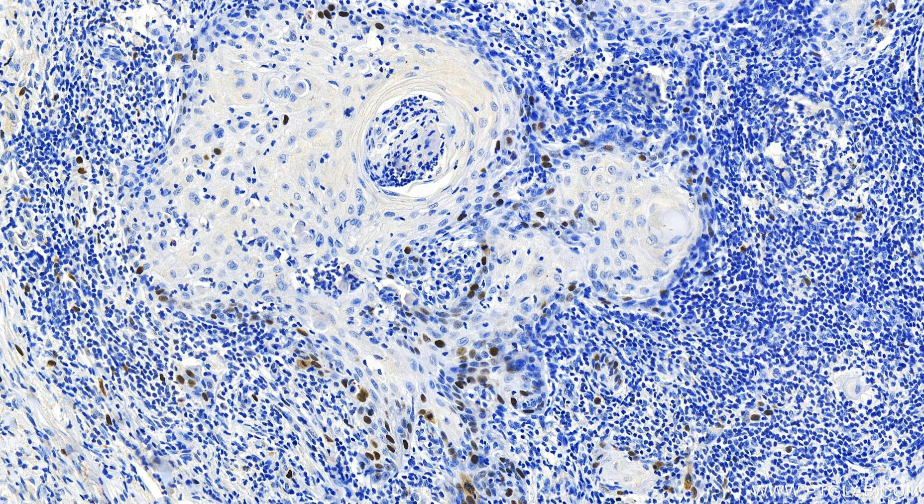 Immunohistochemistry (IHC) staining of human skin cancer tissue using RACGAP1 Recombinant antibody (82788-1-RR)