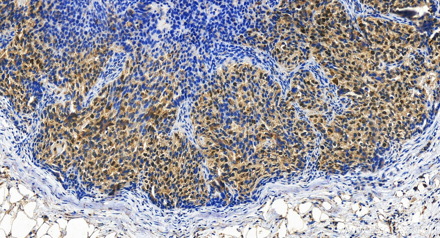 Immunohistochemistry (IHC) staining of human ovary cancer tissue using RAD18 Polyclonal antibody (18333-1-AP)