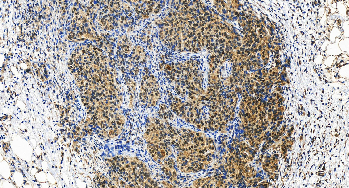 Immunohistochemistry (IHC) staining of human ovary cancer tissue using RAD18 Polyclonal antibody (18333-1-AP)