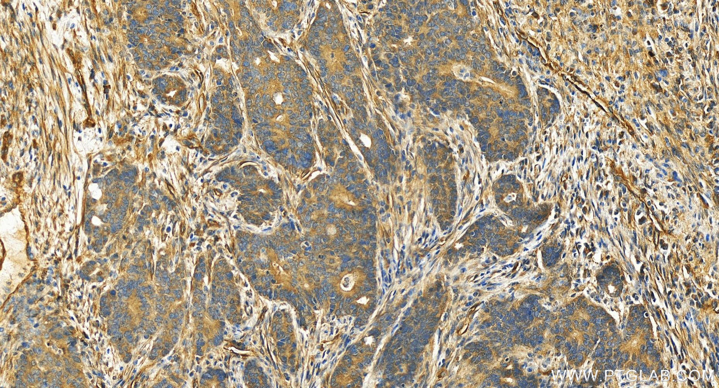 Immunohistochemistry (IHC) staining of human stomach cancer tissue using RAI14 Polyclonal antibody (17507-1-AP)