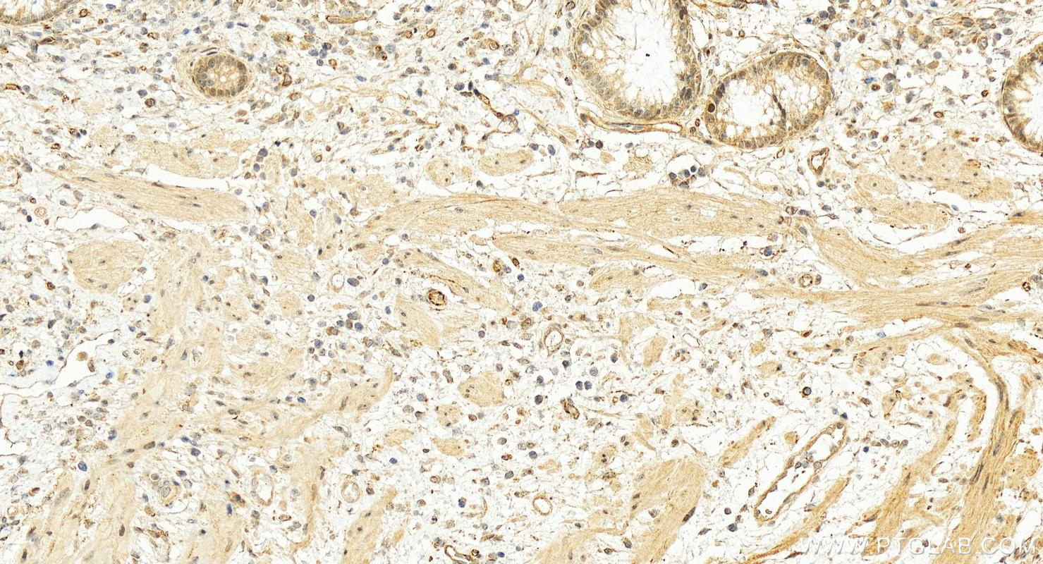 Immunohistochemistry (IHC) staining of human colon cancer tissue using RANGRF Polyclonal antibody (10552-1-AP)