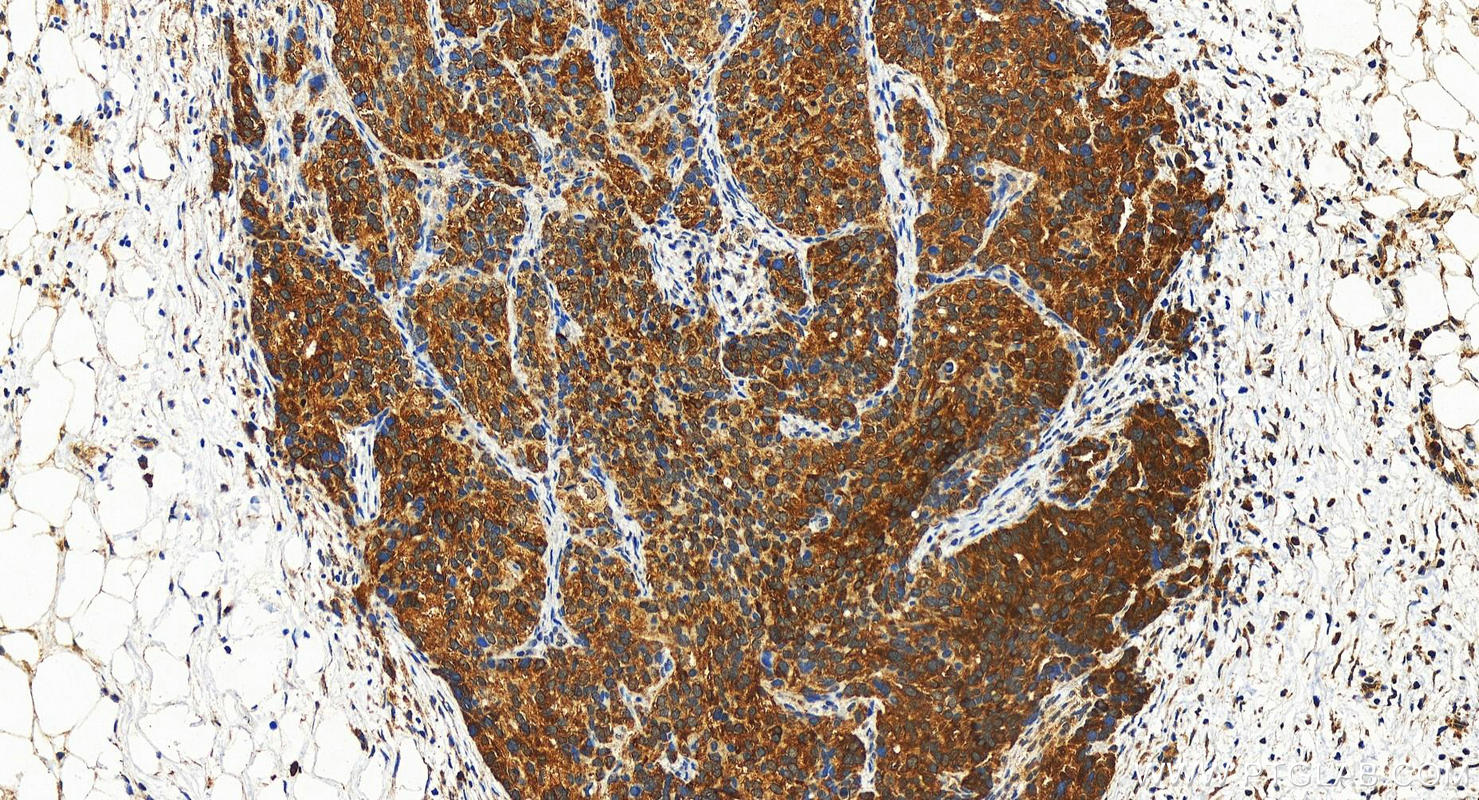 Immunohistochemistry (IHC) staining of human ovary cancer tissue using RAP1GAP Polyclonal antibody (19174-1-AP)