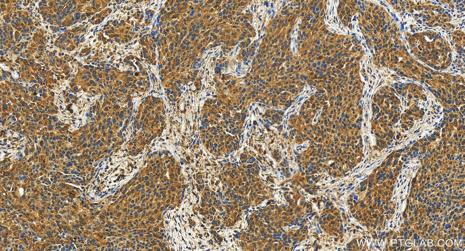 Immunohistochemistry (IHC) staining of human ovary cancer tissue using RARRES1 Polyclonal antibody (27491-1-AP)