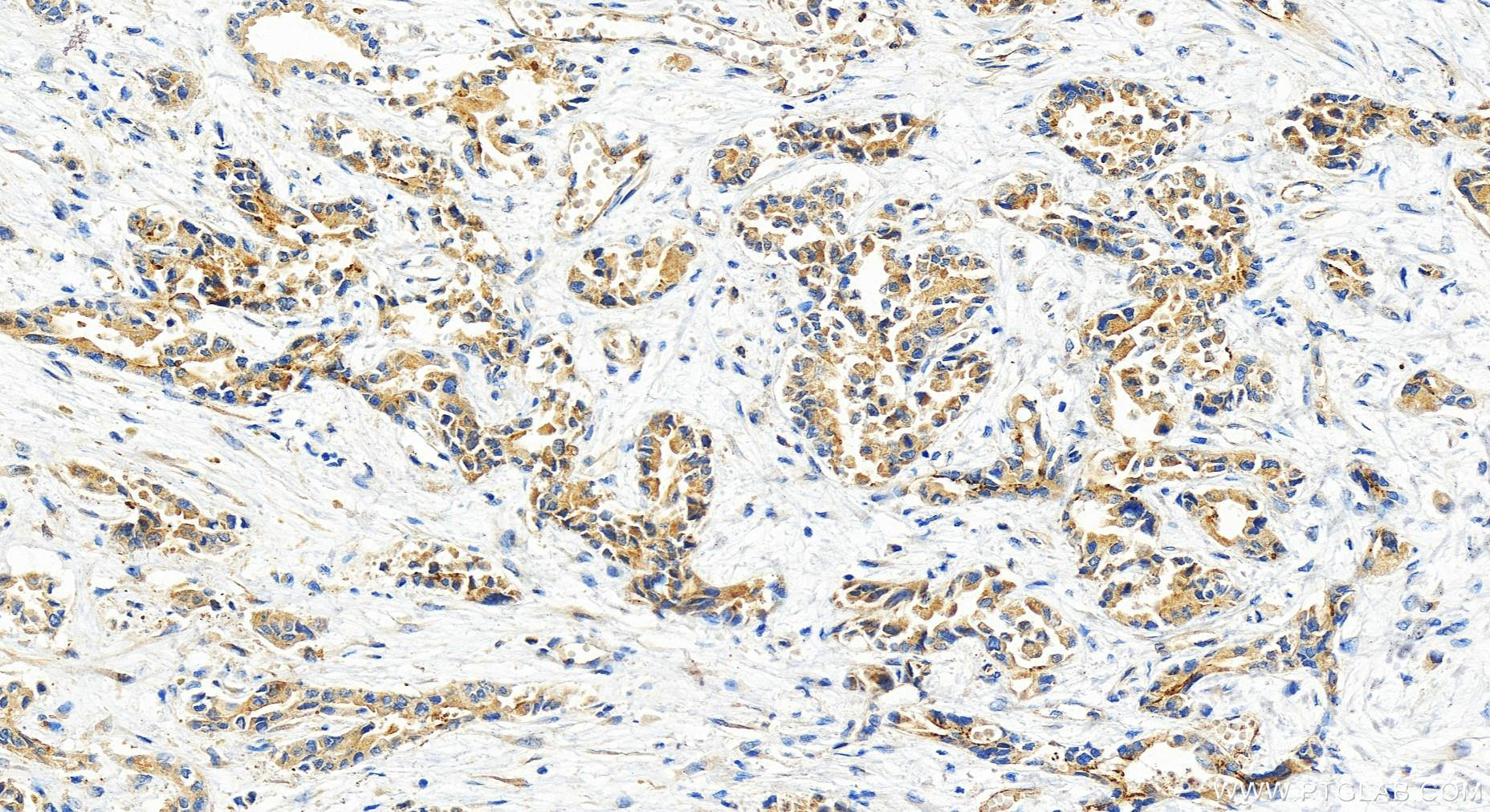 Immunohistochemistry (IHC) staining of human intrahepatic cholangiocarcinoma tissue using RASEF Polyclonal antibody (28162-1-AP)