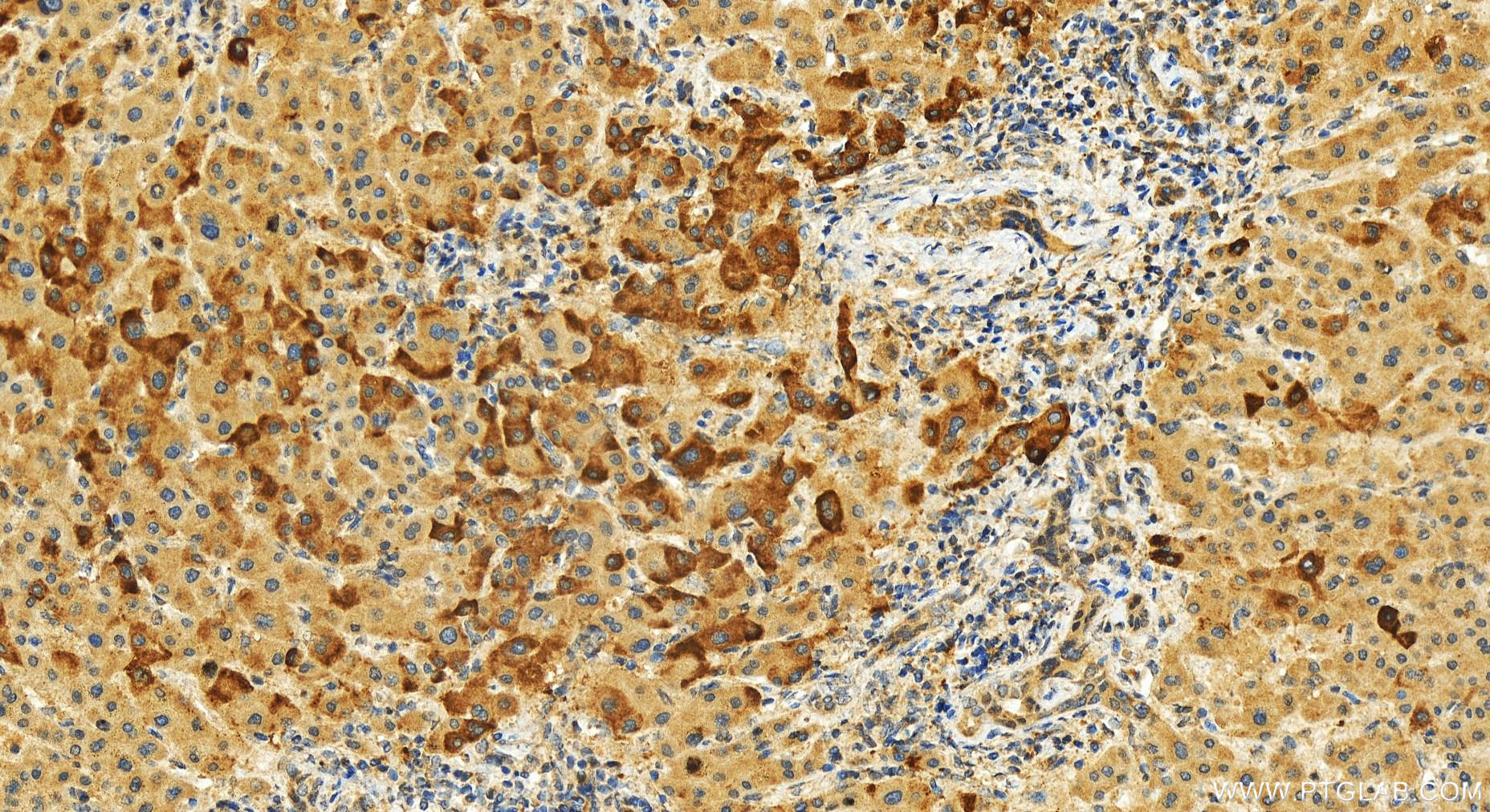 Immunohistochemistry (IHC) staining of human intrahepatic cholangiocarcinoma tissue using RASSF4 Polyclonal antibody (19118-1-AP)