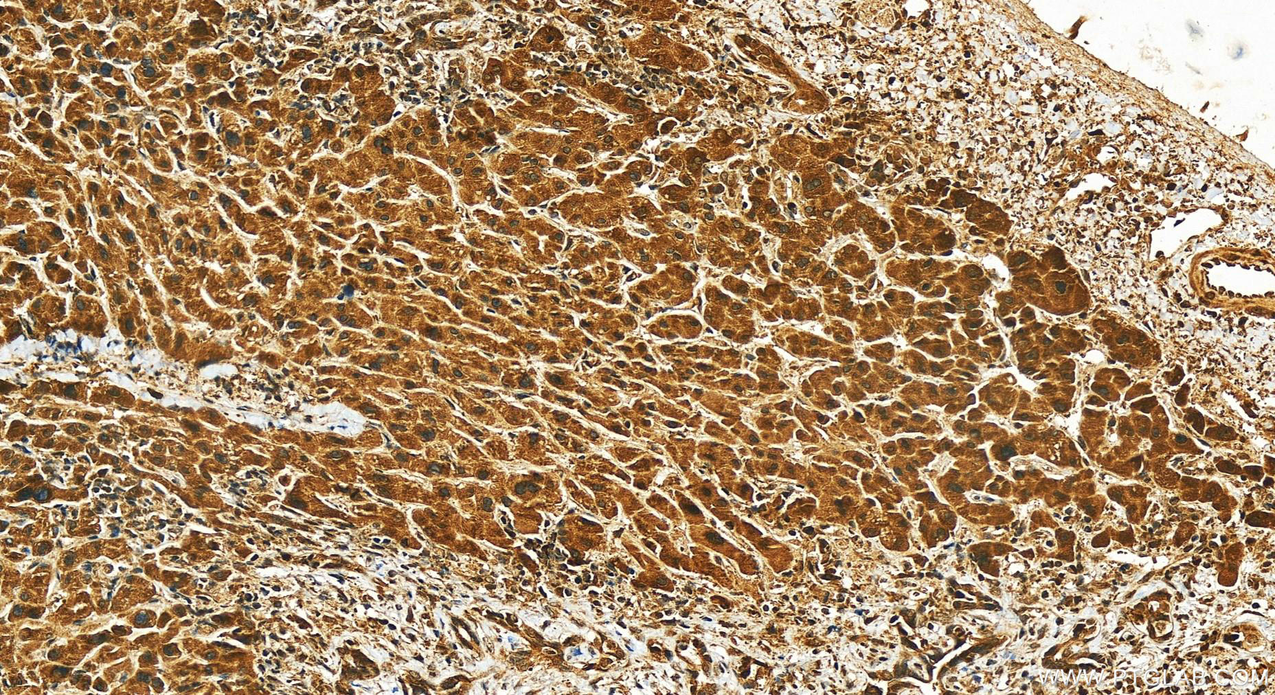 Immunohistochemistry (IHC) staining of human intrahepatic cholangiocarcinoma tissue using RB1 Polyclonal antibody (10048-2-Ig)