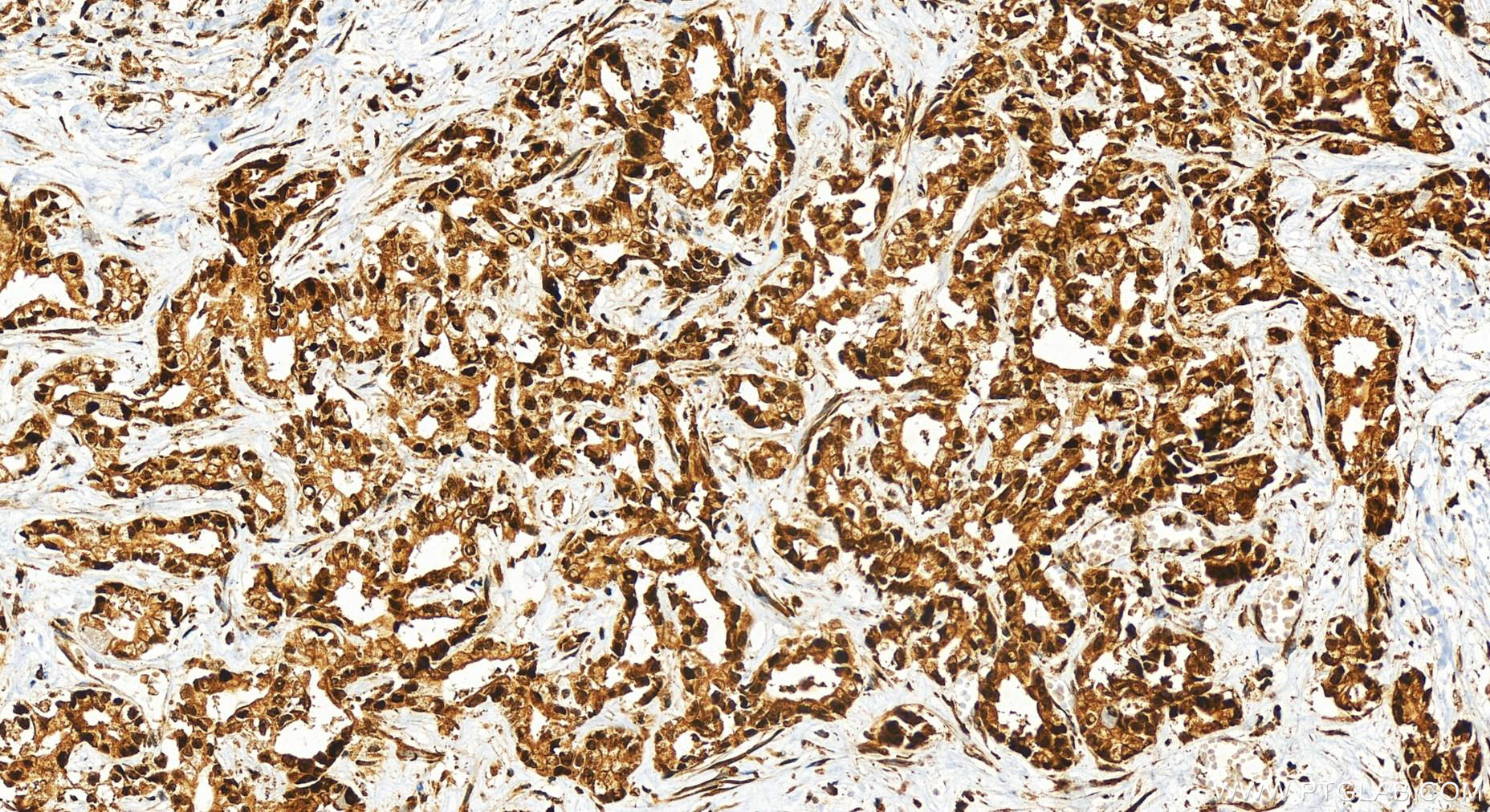 Immunohistochemistry (IHC) staining of human intrahepatic cholangiocarcinoma tissue using RB1 Polyclonal antibody (10048-2-Ig)