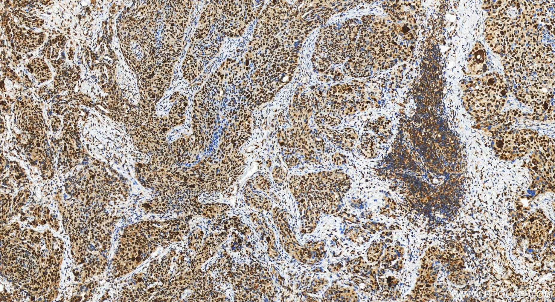 Immunohistochemistry (IHC) staining of human ovary cancer tissue using RB1 Polyclonal antibody (30373-1-AP)