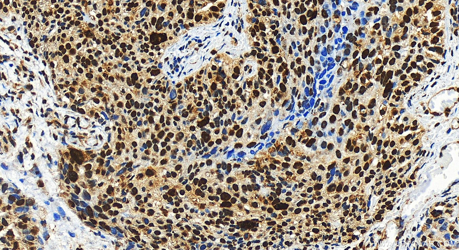 Immunohistochemistry (IHC) staining of human ovary cancer tissue using RB1 Polyclonal antibody (30373-1-AP)