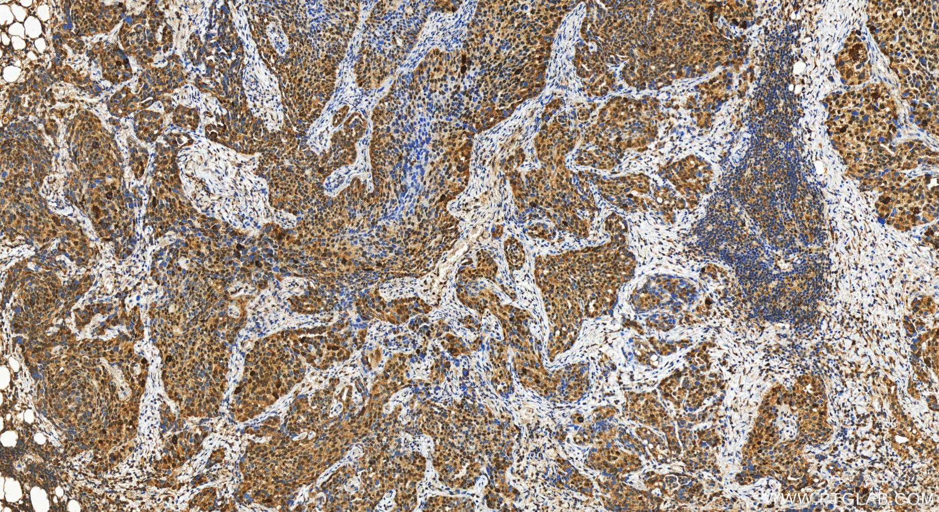 Immunohistochemistry (IHC) staining of human ovary cancer tissue using RB1 Polyclonal antibody (30374-1-AP)