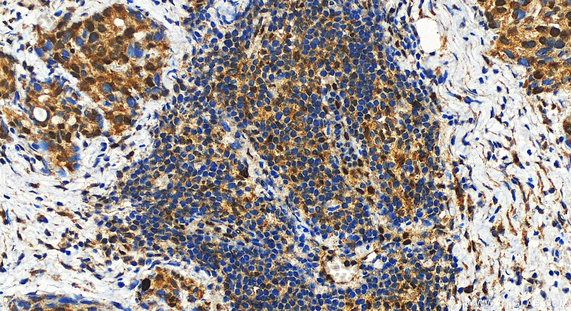 Immunohistochemistry (IHC) staining of human ovary cancer tissue using RB1 Polyclonal antibody (30374-1-AP)