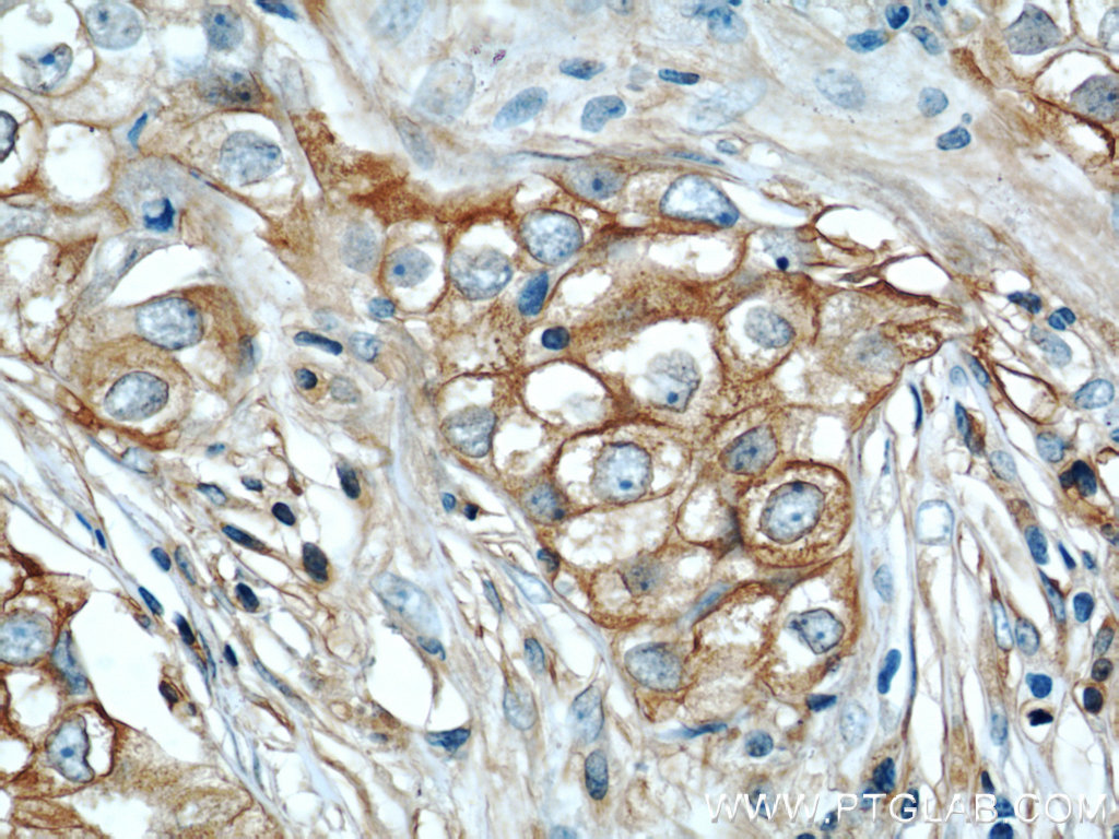 Immunohistochemistry (IHC) staining of human breast cancer tissue using RB1CC1 Polyclonal antibody (10043-2-AP)