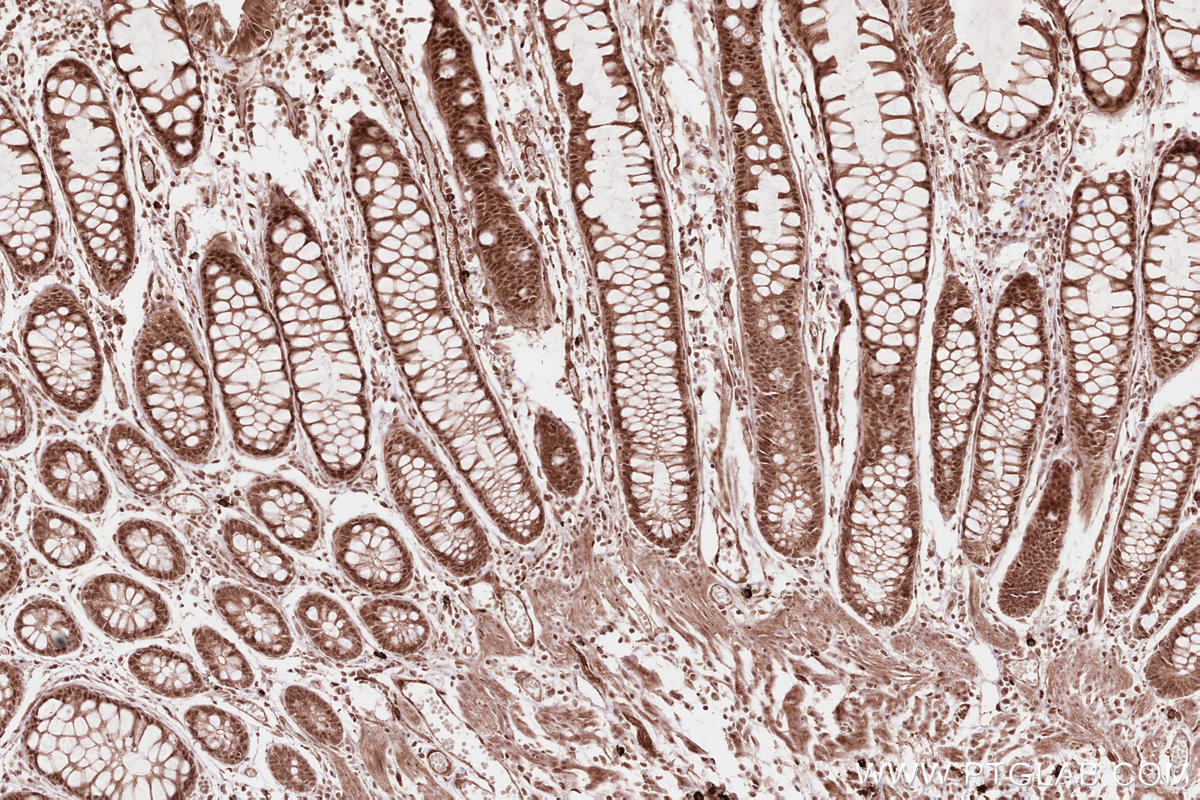 Immunohistochemistry (IHC) staining of human rectal cancer tissue using RBBP6 Polyclonal antibody (11882-1-AP)