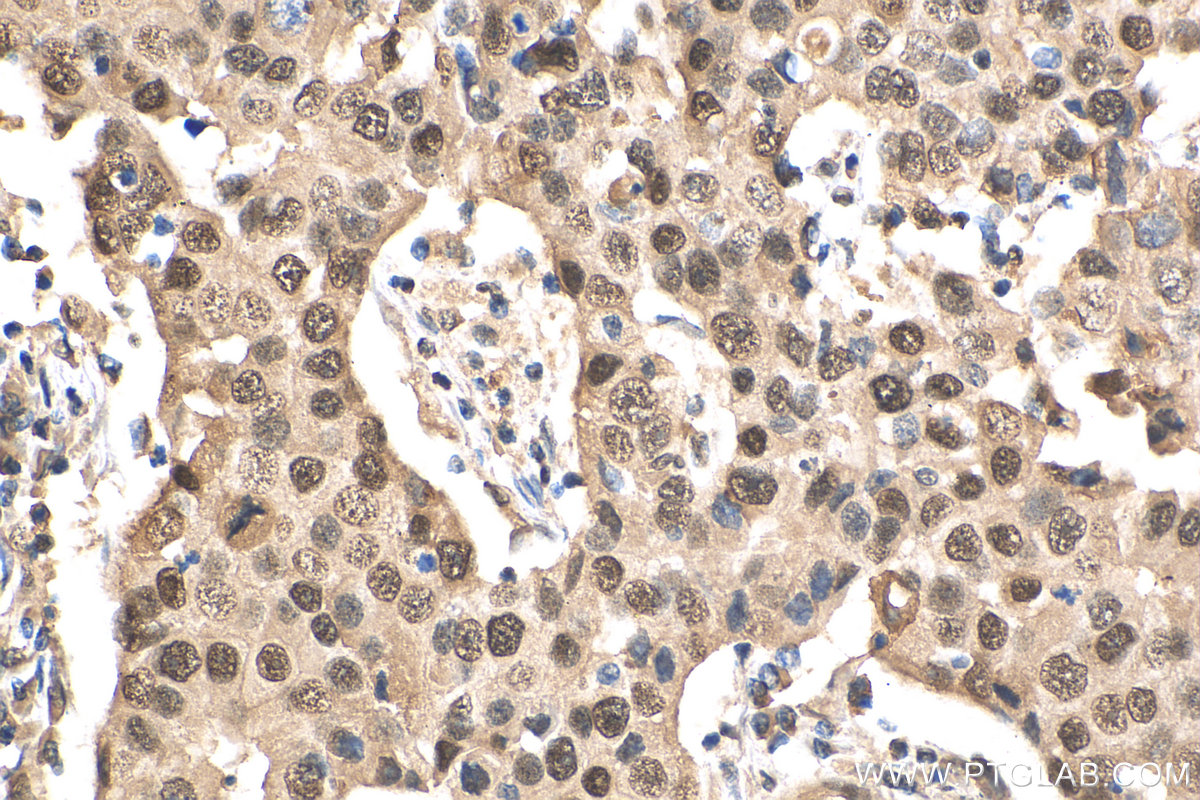 Immunohistochemistry (IHC) staining of human breast cancer tissue using RbAp46 Polyclonal antibody (20365-1-AP)