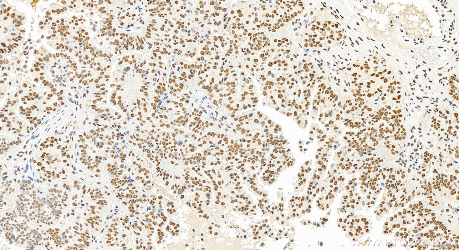 Immunohistochemistry (IHC) staining of human ovary cancer tissue using RBM17 Polyclonal antibody (13918-1-AP)