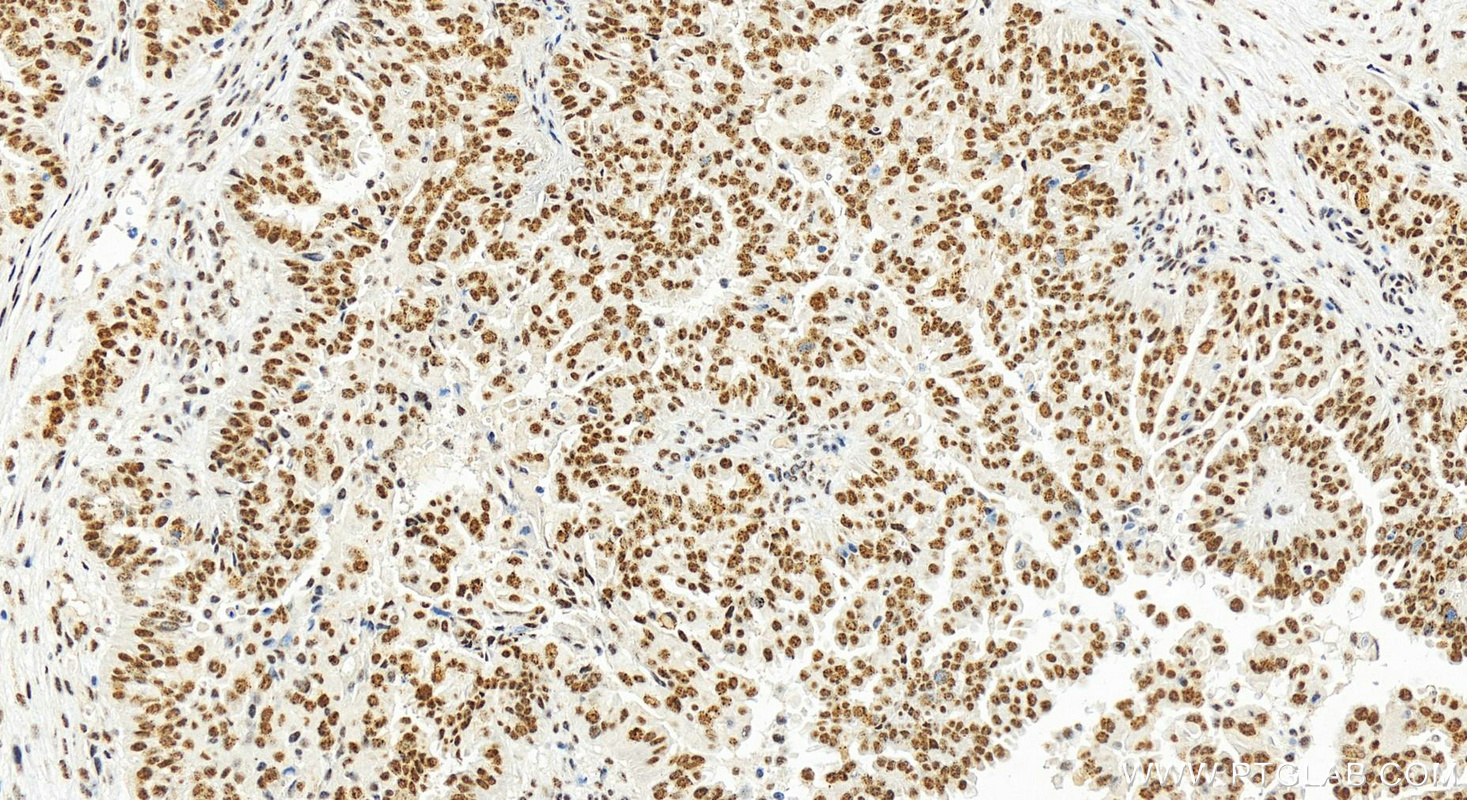 Immunohistochemistry (IHC) staining of human ovary cancer tissue using RBM17 Polyclonal antibody (15374-1-AP)