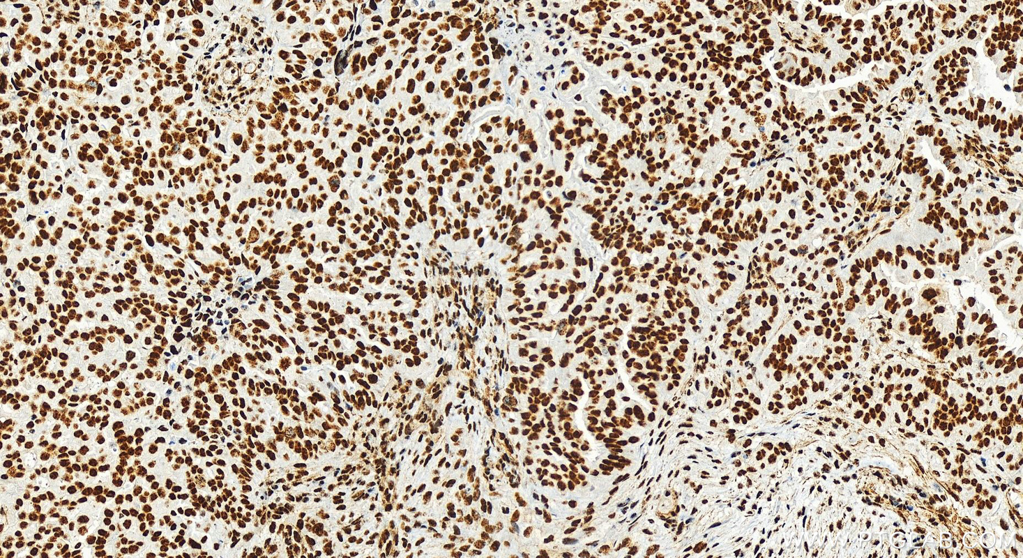 Immunohistochemistry (IHC) staining of human ovarian  cancer using RBM17 Recombinant antibody (82889-3-RR)