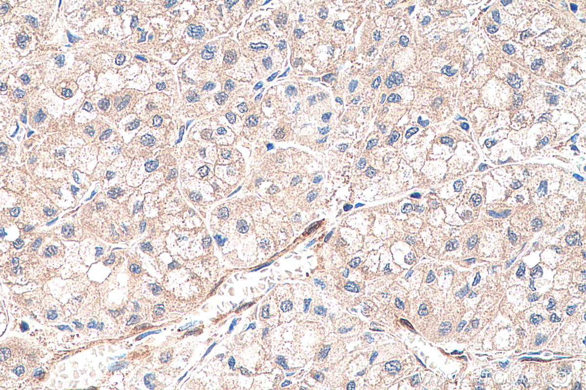 Immunohistochemistry (IHC) staining of human liver cancer tissue using RBP1 Polyclonal antibody (22683-1-AP)