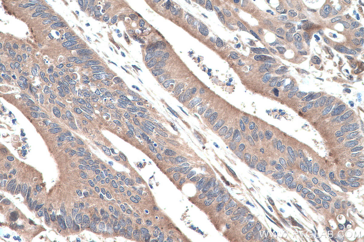 Immunohistochemistry (IHC) staining of human colon cancer tissue using RBP1 Polyclonal antibody (22683-1-AP)